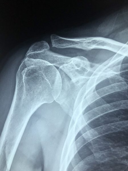 Shoulder pain after a car accident may not appear in an X-ray, like this one