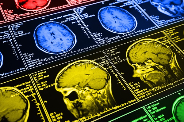 Magnetic resonance scan of the brain.